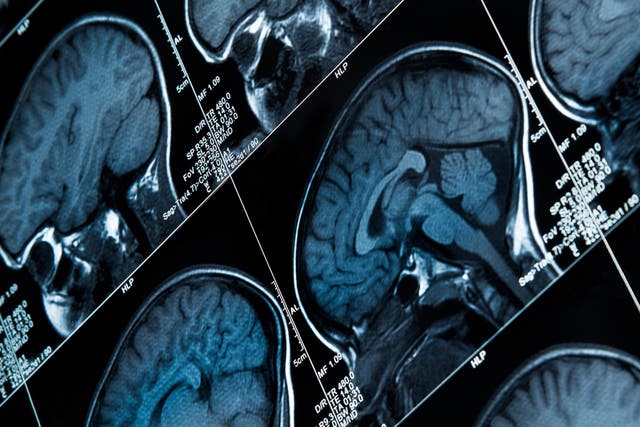 <p>FCDs can sometimes be missed by radiologists</p>