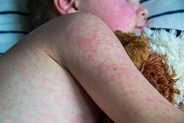 <p>Two dozen people in Texas have been stricken with the highly contagious measles virus. Many of those infected are unvaccinated, school-aged children</p>